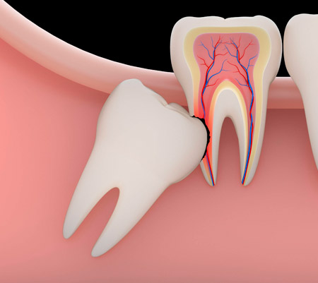 Рекомендации после удаления зубов