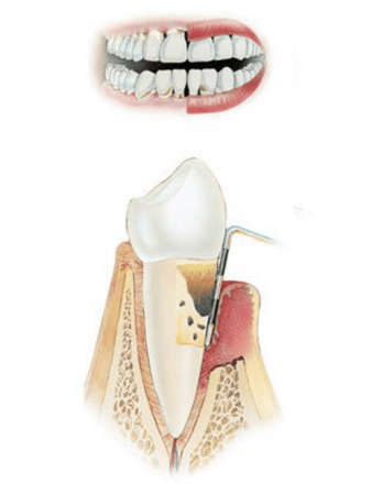 Зубной пародонтоз