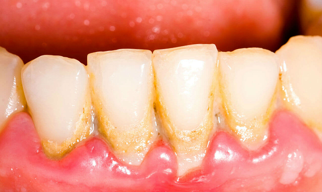 зубные отложения